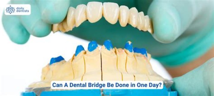 Can a dental bridge be done in one day?