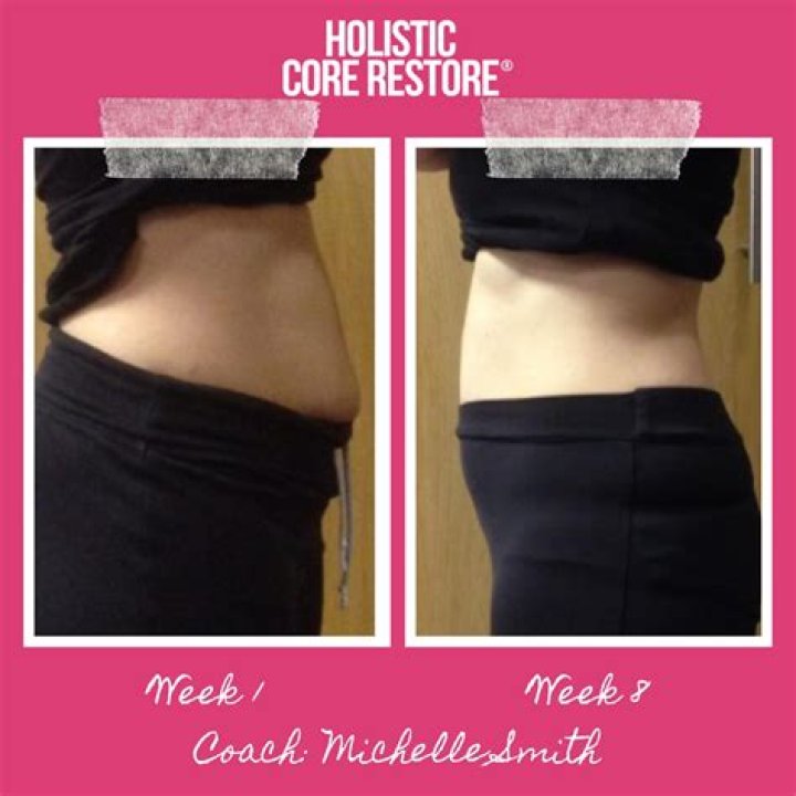 Can diastasis recti be fixed?