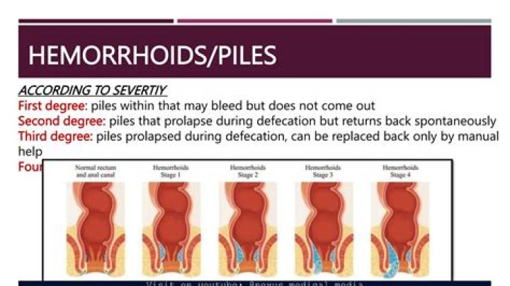 Does walking help hemorrhoids?